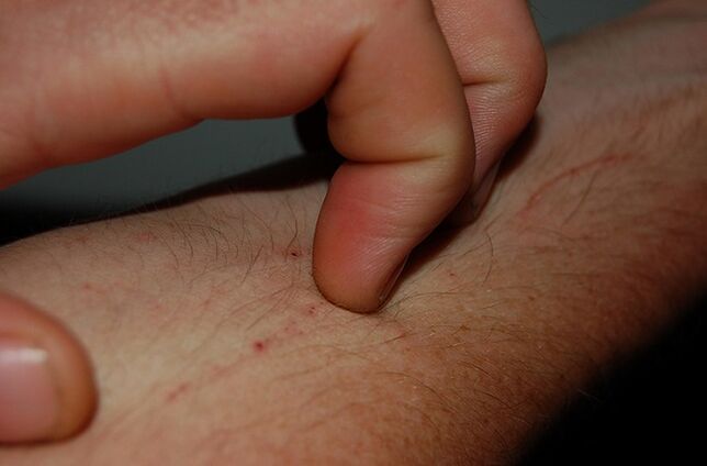 swędzenie skóry jako objaw obecności pasożytów